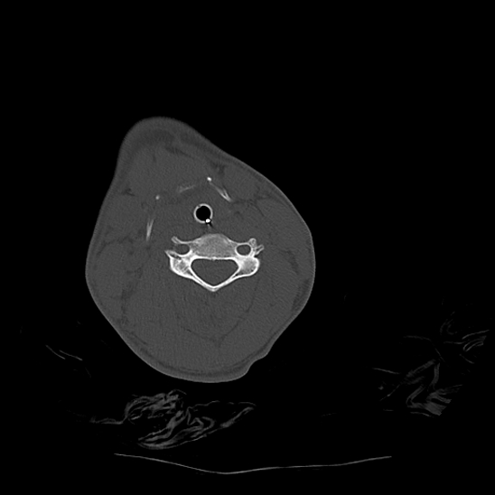 File:Atlanto-occipital dissociation (Traynelis type 1), C2 teardrop fracture, C6-7 facet joint dislocation (Radiopaedia 87655-104061 Axial bone window 49).jpg