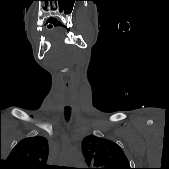 File:Atlanto-occipital dissociation (Traynelis type 1), C2 teardrop fracture, C6-7 facet joint dislocation (Radiopaedia 87655-104061 Coronal bone window 15).jpg
