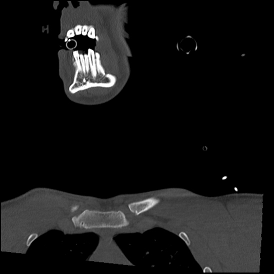 Atlanto-occipital dissociation (Traynelis type 1), C2 teardrop fracture, C6-7 facet joint dislocation (Radiopaedia 87655-104061 Coronal bone window 4).jpg