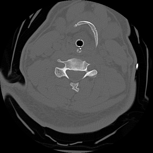 Atlanto-occipital dissociation injury (Radiopaedia 29274-29698 Axial bone window 45).png
