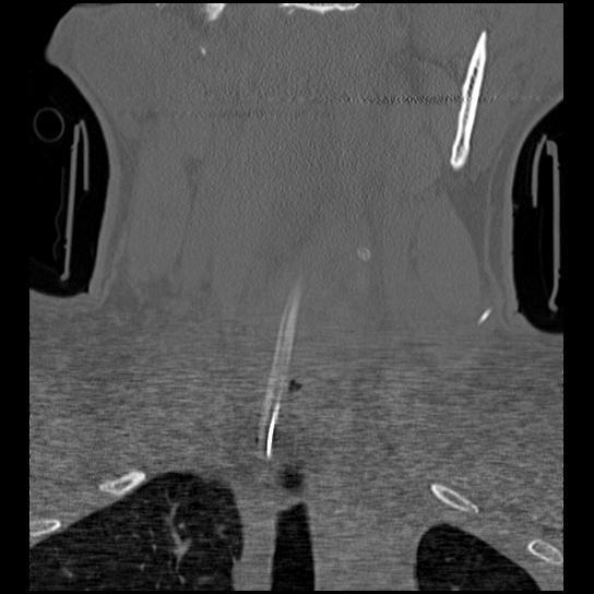Atlanto-occipital dissociation injury (Radiopaedia 29274-29698 Coronal bone window 35).png