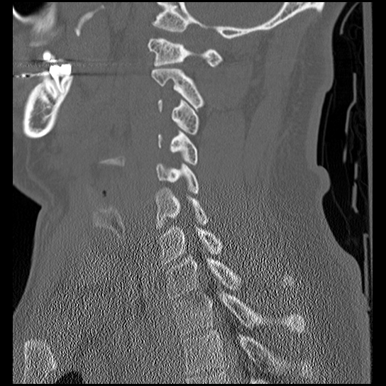 File:Atlanto-occipital dissociation injury (Radiopaedia 29274-29698 Sagittal bone window 37).png