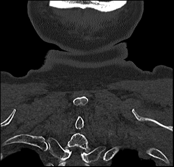 File:Atlas (type 3b subtype 1) and axis (Anderson and D'Alonzo type 3, Roy-Camille type 2) fractures (Radiopaedia 88043-104607 Coronal bone window 60).jpg