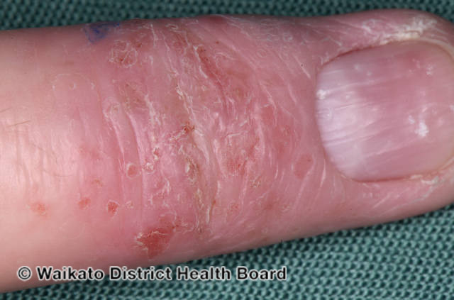 File:Atopic hand eczema (DermNet NZ atopic-eczema-03).jpg