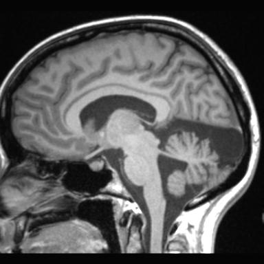 File:Atretic encephalocoele with inferior vermis hypoplasia (Radiopaedia 30443-31108 Sagittal T1 70).jpg