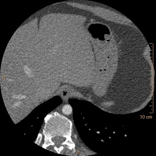 Atrial septal defect (upper sinus venosus type) with partial anomalous pulmonary venous return into superior vena cava (Radiopaedia 73228-83961 A 280).jpg