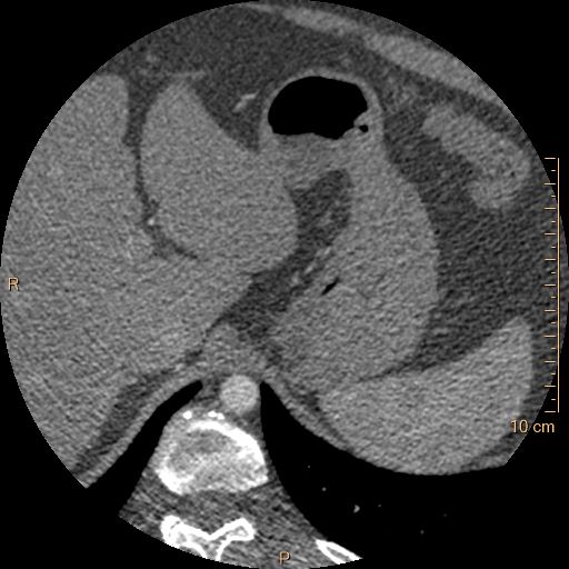 File:Atrial septal defect (upper sinus venosus type) with partial anomalous pulmonary venous return into superior vena cava (Radiopaedia 73228-83961 A 313).jpg