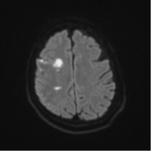 Atypical meningioma (WHO Grade II) (Radiopaedia 54742-60979 Axial DWI 48).png