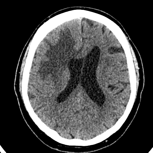 File:Atypical meningioma (WHO grade II) with brain invasion (Radiopaedia 57767-64728 Axial non-contrast 26).png