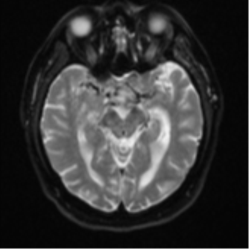 File:Atypical meningioma (WHO grade II) with brain invasion (Radiopaedia 57767-64729 Axial DWI 12).png