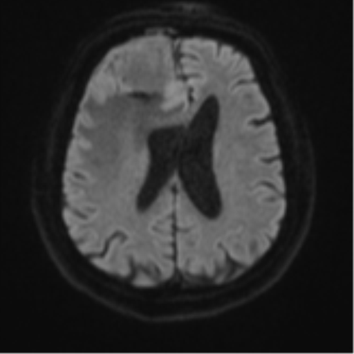 Atypical meningioma (WHO grade II) with brain invasion (Radiopaedia 57767-64729 Axial DWI 49).png