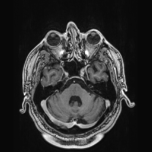 File:Atypical meningioma (WHO grade II) with brain invasion (Radiopaedia 57767-64729 Axial T1 C+ 12).png