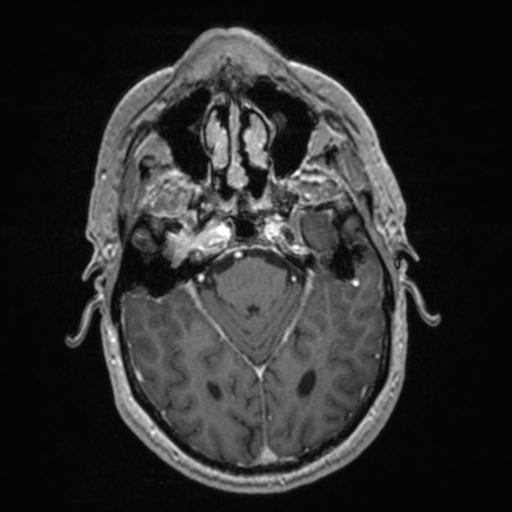 Atypical meningioma (grade II) - en plaque (Radiopaedia 29633-30147 Axial T1 C+ 64).jpg
