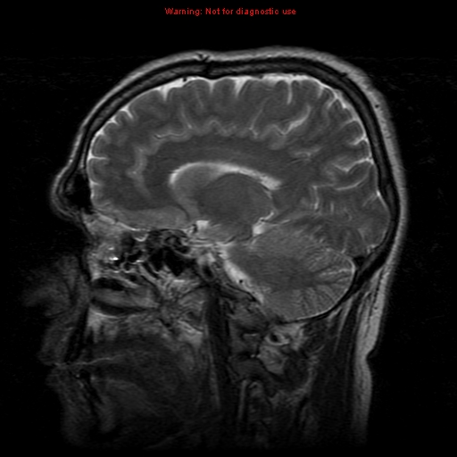 File:Atypical meningioma - grade II (Radiopaedia 13303-13305 Sagittal T2 14).jpg