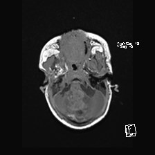 File:Atypical teratoid rhabdoid tumor (prenatal US and neonatal MRI) (Radiopaedia 59091-66388 Axial T1 11).jpg
