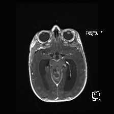 Atypical teratoid rhabdoid tumor (prenatal US and neonatal MRI) (Radiopaedia 59091-66388 Axial T1 C+ 26).jpg