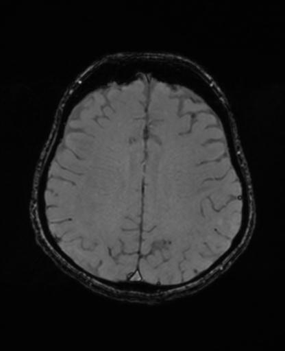 File:Autoimmune limbic encephalitis (Radiopaedia 30363-31005 SWI - magnitude 54).jpg