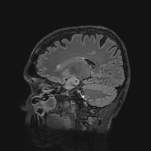 Autoimmune limbic encephalitis (Radiopaedia 30363-31005 Sagittal FLAIR 63).jpg