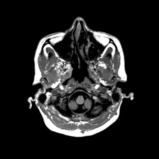 Autoimmune limbic encephalitis (Radiopaedia 30363-31005 T1 Axial 1mm 23).jpg