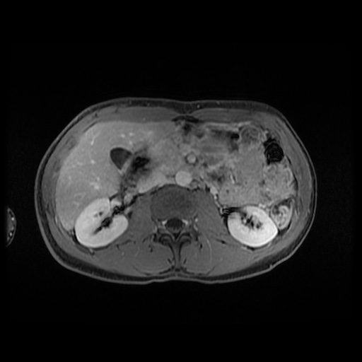 Autoimmune pancreatitis (Radiopaedia 69751-79729 Axial T1 C+ fat sat 75).jpg