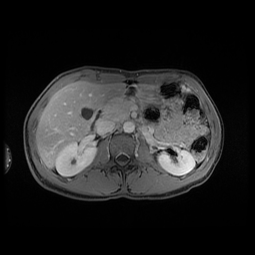 File:Autoimmune pancreatitis (Radiopaedia 69751-79729 N 68).jpg