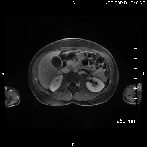 Autoimmune pancreatitis (Radiopaedia 88443-105101 A 74).jpg