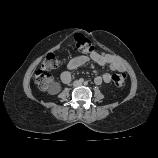 Autosomal dominant polycystic kidney disease (Radiopaedia 38189-40194 Axial C+ delayed 32).jpg