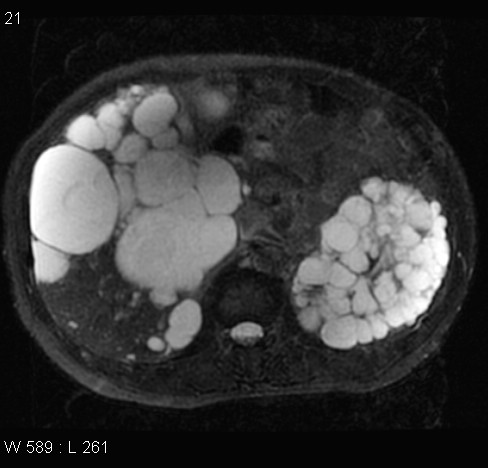 File:Autosomal dominant polycystic kidney disease (Radiopaedia 5202-6969 Axial T2 fat sat 8).jpg