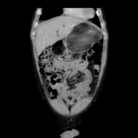 Autosomal dominant polycystic kidney disease (Radiopaedia 66349-75582 A 6).jpg