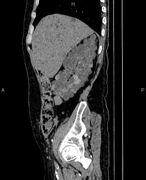 Autosomal dominant polycystic kidney disease (Radiopaedia 87830-104287 C 19).jpg