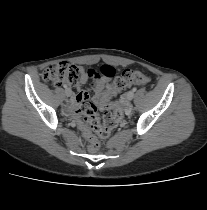 Autosomal dominant polycystic kidney disease - early onset (Radiopaedia 40734-43387 A 70).jpg