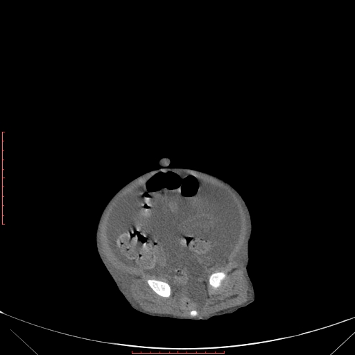 Autosomal recessive polycystic kidney disease associated with Caroli disease (Radiopaedia 61932-69984 Axial non-contrast 315).jpg