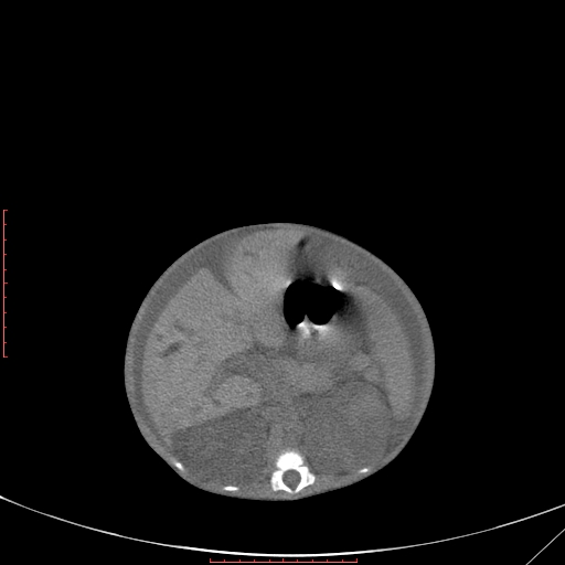 Autosomal recessive polycystic kidney disease associated with Caroli disease (Radiopaedia 61932-69984 B 172).jpg