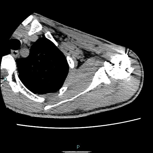 Avascular necrosis after fracture dislocations of the proximal humerus (Radiopaedia 88078-104653 D 35).jpg