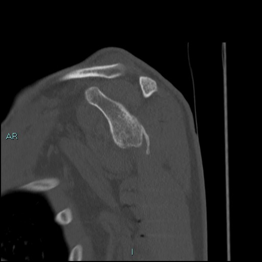 Avascular necrosis after fracture dislocations of the proximal humerus (Radiopaedia 88078-104653 Sagittal bone window 38).jpg