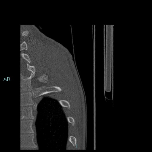 File:Avascular necrosis after fracture dislocations of the proximal humerus (Radiopaedia 88078-104655 Sagittal bone window 101).jpg
