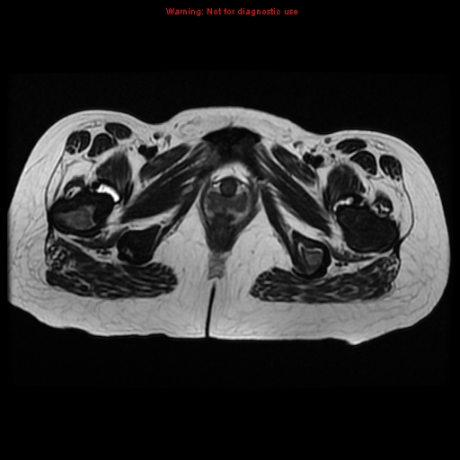 File:Avascular necrosis in sickle cell disease (Radiopaedia 17448-17151 Axial T2 14).jpg