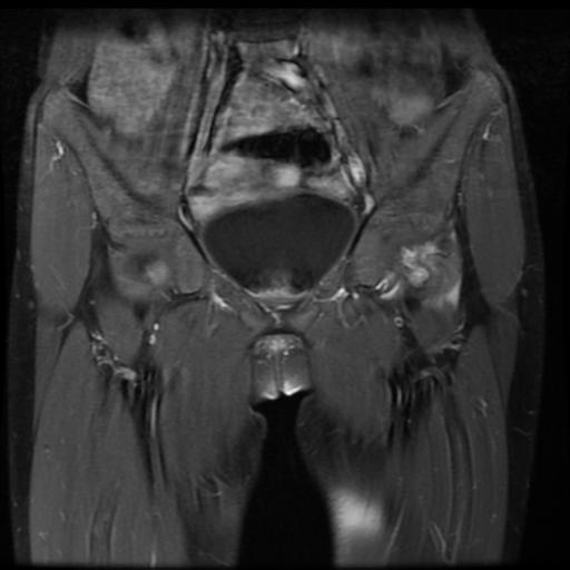 File:Avascular necrosis of the hip (Radiopaedia 29563-30067 I 4).jpg