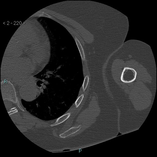 File:Avascular necrosis of the shoulder - Cruess stage I (Radiopaedia 77674-89887 Axial bone window 55).jpg