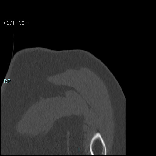 Avascular necrosis of the shoulder - Cruess stage I (Radiopaedia 77674-89887 Coronal bone window 91).jpg