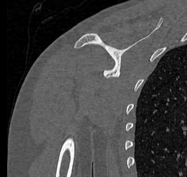 Avulsion fracture - greater tuberosity of humerus (Radiopaedia 71216-81514 Coronal bone window 46).jpg