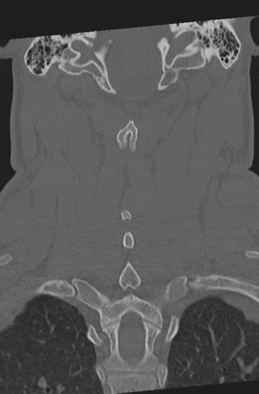 Axis peg fracture (type 3) and atlas lateral mass (type 4) fracture (Radiopaedia 37474-39324 Coronal bone window 40).png