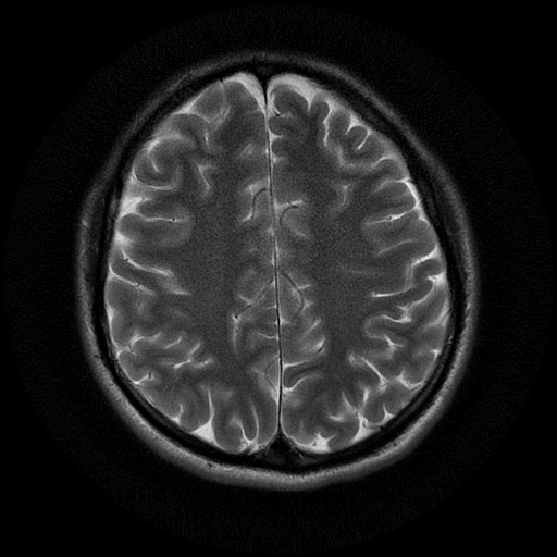 File:Azygos anterior cerebral artery (Radiopaedia 17059-16756 Axial T2 7).jpg