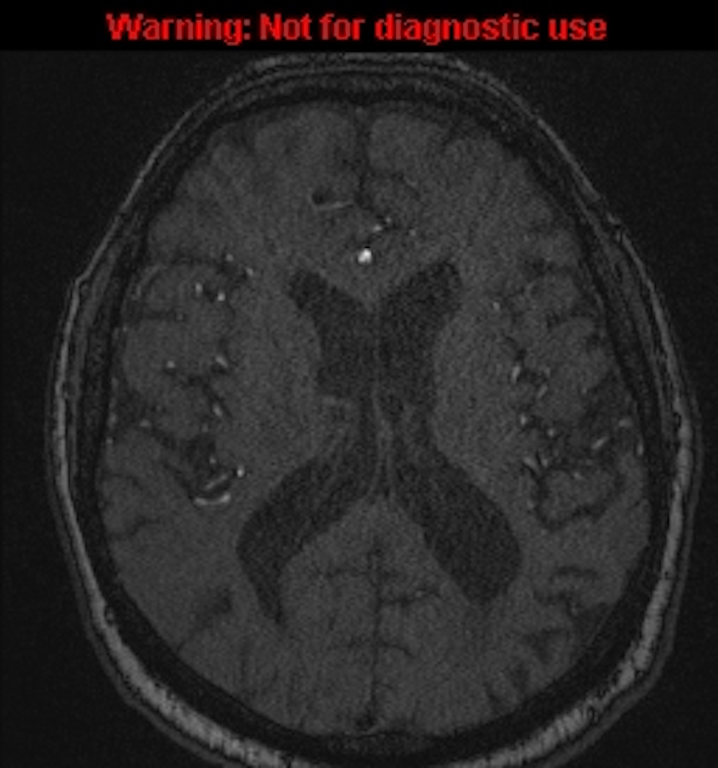 Azygos anterior cerebral artery (Radiopaedia 59325-66677 Axial MRA 103).jpg