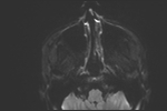 File:Basal cell carcinoma - nasal region (Radiopaedia 70292-80365 Axial DWI 32).jpg