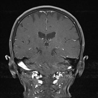 File:Base of skull chondrosarcoma (Radiopaedia 30410-31070 G 15).jpg