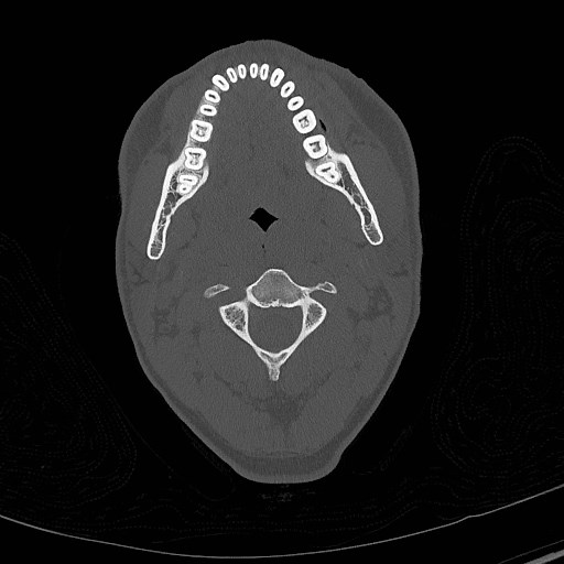 Base of skull fracture with bilateral Le Fort fractures (Radiopaedia 47094-51638 Axial bone window 1).jpg