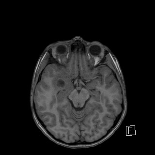 File:Base of skull rhabdomyosarcoma (Radiopaedia 32196-33142 Axial T1 21).jpg