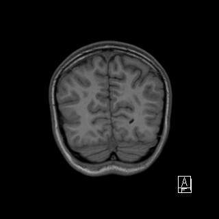 Base of skull rhabdomyosarcoma (Radiopaedia 32196-33142 Coronal T1 44).jpg
