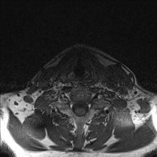 File:Base of tongue squamous cell carcinoma (Radiopaedia 31174-31884 Axial T1 2).jpg